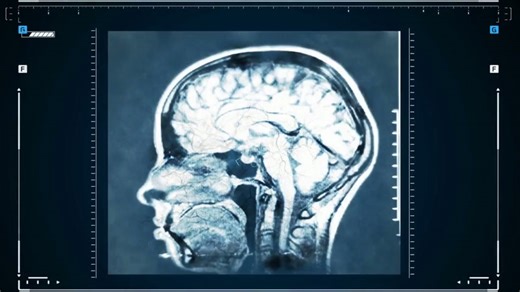 What aphasia does to your brain