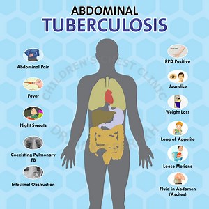 Abdominal Tuberculosis in Children - Dr. Ankit Parakh – India's best Pediatric Pulmonologist | Chest Specialist