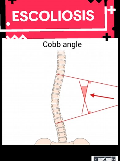 Cómo medir el ángulo de Cobb en 1 minuto