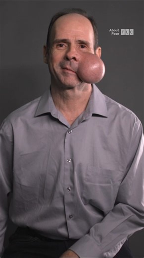 Ron's severe facial tumor limits his ability to eat, drink, and live his daily life. See how an elite group of surgeons turn his story around on the new series #AboutFace, Wednesdays at 10/9c on TLC. | TLC