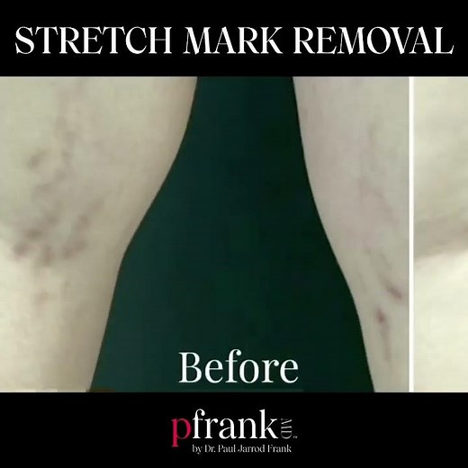 Stretch Mark Removal (Red Stretch Marks) Before and After