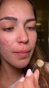 80K views · 235 reactions |  You won't believe what came out of this one... #pimplepop #satisfying | Pimple Popping | Facebook