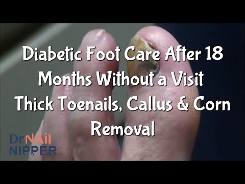 Classic - Diabetic Foot Care After 18 Months Without a Visit | Thick Toenails, Callus & Corn Removal