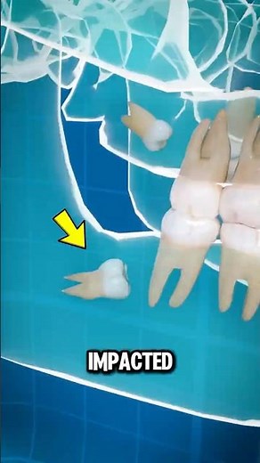 Why Wisdom Teeth Cause So Much Pain