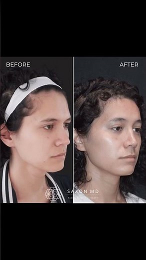 Facial Feminization Surgery (FFS) Before and After, Dr. Sarah Saxon