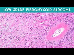 Low grade fibromyxoid sarcoma (LGFMS) (Evans tumor) (explained in 5 minutes) pathology