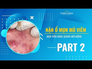 Nặn ổ mụn mủ, mụn nhọt, mụn viêm nặng quanh mũi miệng nan mun mu xem nan mun ghien nan mun Part2