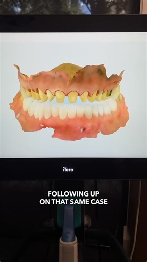 Cosmetic | Restorative | Implant Dentistry on Instagram: "🦷 Managing Complex Occlusion with Precision In this case, we utilized a deprogrammer to open the vertical dimension and stabilize the bite. ✅ Completed the lower arch to perfection ✅ Designed and prepped the upper arch ✅ Deprogrammed between steps to ensure proper seating & occlusion The patient is now comfortably temporized — with a stable foundation for their final upper restoration. ✨ . . . #RitterAndRamsey #TheProtocol #Occlusion #De