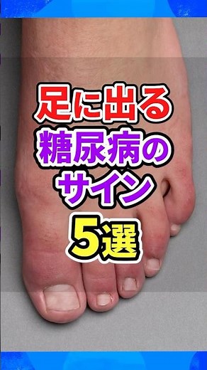 500,000 views! 5 warning signs of diabetes you can spot just by looking at your feet