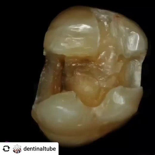 This is a really cool graphic of the before and after effects of Air Abrasion! (The surface looks so much more bondable after Air Abrasion!) Reposted from: @dentinaltube "Sandblasting (air particle abrasion) removes some things you don't want in your prep and helps you see other things you may need to address in your prep. Also it helps make your preps smooth and "thirsty" for the adhesive and composite to adapt to. I love sandblasting after I think I have removed all old composite or amalgam be
