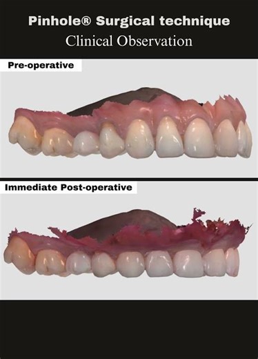 Clinical Observation — Gingival Recession