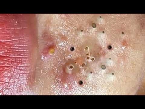 Blackheads Removal || Acne Removal - 0252 #glowup #acne #blackheads