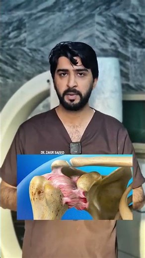 Frozen shoulder, also called adhesive capsulitis, involves stiffness and pain in the shoulder joint.