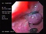 Banding of esophageal varices (4 of 17) • Video • MEDtube.net