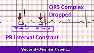 Second-Degree Type II AV Heart Block (Mobitz II) ECG Review