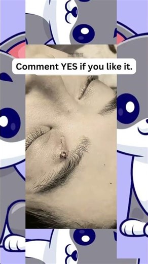 🔥Deep Blackheads, Milia & Whitehead Removal pimple popping New| Big Cystic Acne Extraction