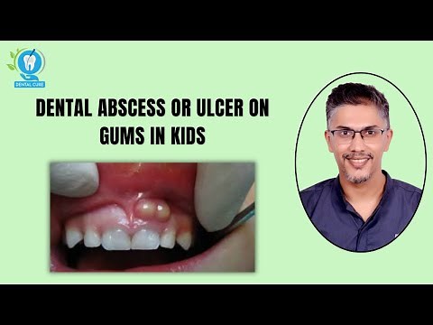 Dealing with Dental Abscess or Ulcer on Gums in Kids: Causes, Symptoms, and Treatment.