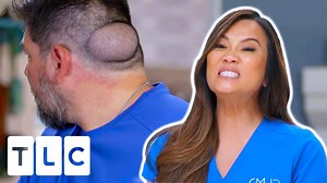 As an ex-bodybuilder, Reuben knows how to look after his appearance. But he has had this big bump on the back of his head for a long time now, and it’s really affected his self-esteem. | Dr. Pimple Popper 1312 #pimple #popper #drpimplepopper #drsandralee | Pimple Daily Post