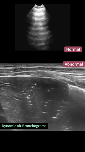 Dynamic Air Bronchogram on Lung Ultrasound Explained #ultrasound #sonography #sonographer