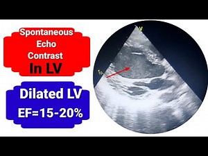 Spontaneous echo contrast/ SEC / Smoke in Left ventricle in Echocardiogrphy