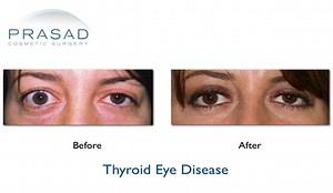 Causes of a Protruding Eye — See What the Doctor Recommends for This Woman