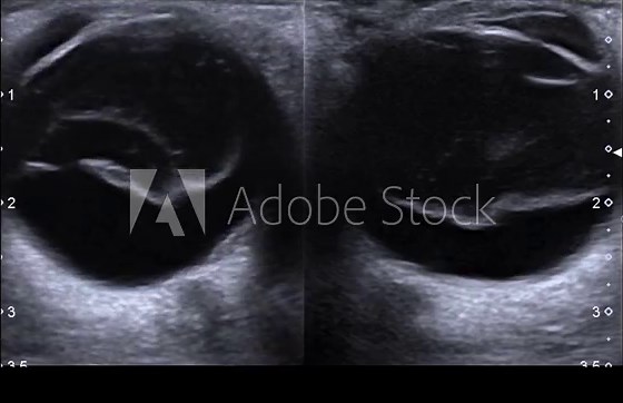 Posterior vitreous detachment.USG Posterior vitreous detachment.USG Posterior vitreous detachment