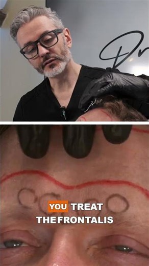 Frontalis vs corrugator: the mistake causing heaviness
