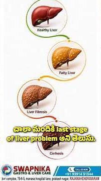 Cirrhosis explained by gastroenterologist Rajahmundry| signs of advanced liver damage