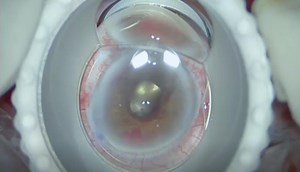 Combined Vitrectomy and Glaucoma Surgery - Eyetube