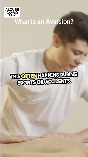 Avulsion Fracture Explained in 60 Seconds | Causes, Symptoms & Treatment