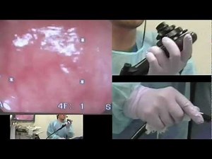 Colonoscopy ; consecutive cases 15/20