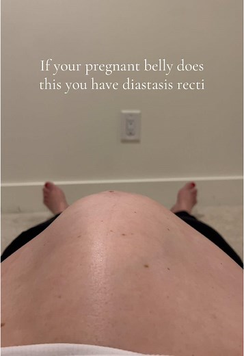 Understanding Diastasis Recti During Pregnancy Symptoms