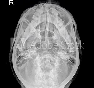Submentovertex View Skull X-ray Imaging: Detailed Assessment of Cranial Structures and Mandibular Relationships
