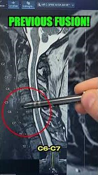 What happens after a SPINAL FUSION?