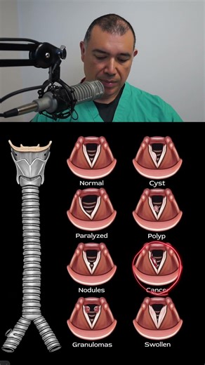 Voice box and hoarseness #shorts
