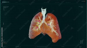 Molecular Scanner Computer Checks Lungs For Cancer Disease. Analysis Of Patients Respiratory System In Interface Of Molecular Scanner Computer. Molecular Scanner Computer Discovers Abnormal Growth