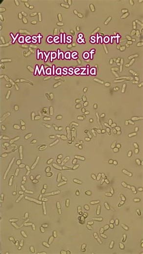 Yeast cells and Short hyphae of Malassezia #shorts #science