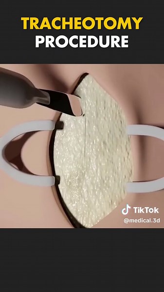 Tracheotomy Procedure 3D Animation #tracheotomy #tracheostomia #tracheotomytube #tracheotomyawareness #windpipe #windpipesurgery #tracheasurgery #patienteducation #medical3danimation #3dmedicalanimation #tracheotomyairwayreconstruction
