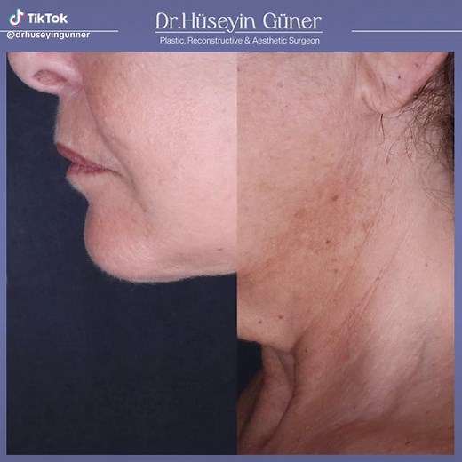 Before & After of neck lift and liposuction 🙌🏼 #necklift #laserliposuction #neck