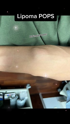 Lipomas can scary but the pop can be so #satisfying #drpimplepopper #SLMDskincare