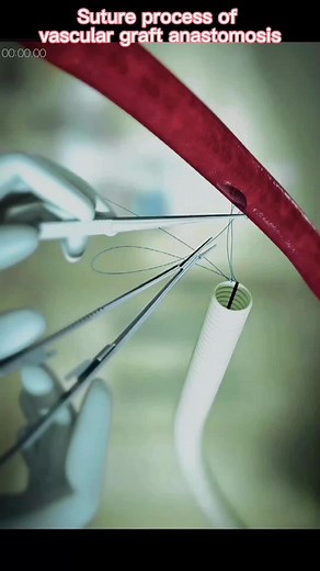 Vascular Graft Anastomosis: Surgical Suture Process