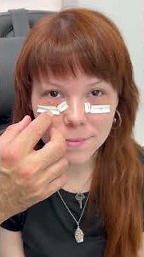 Lower blepharoplasty fat repositioning fat grafting and co2 laser