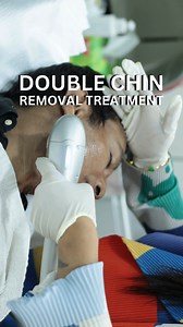 Double Chin Removal #doublechin #doublechinreduction #hifutreatment | Sedona Aesthetic Derma & Laser Center