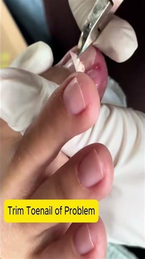 Technical is trim toenail Part 159