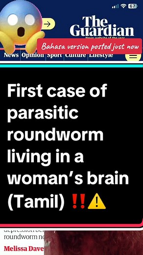 Parasitic roundworm found living in a woman’s brain for almost 2years: First case in the world ‼️⚠️#fypviral #tamiltiktok #roundworm #parasiticworm #womanbrain #scarydiscoveries #beaware #tiktoktamil #foryoupagetamil