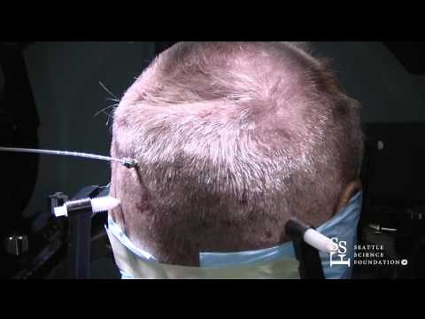 MRI Guided Laser Amygdalohippocampectomy with Visualase Demo by Andrew Ko, MD