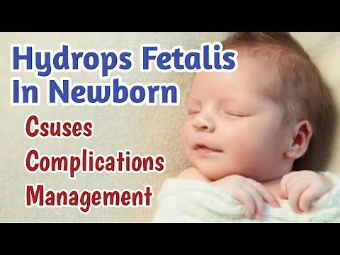 Hydrops Fetalis In Newborn Baby | Fetal Hydrops Causes, Complications, Treatment & Prognosis