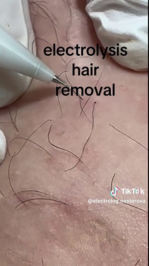 Electrolysis Hair Removal Techniques Explained