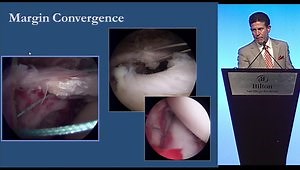 How To Fix The Cuff: Single and Double Row Technique