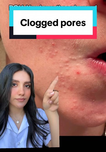 Adapalene Gel for Clogged Pores: Key Benefits Explained